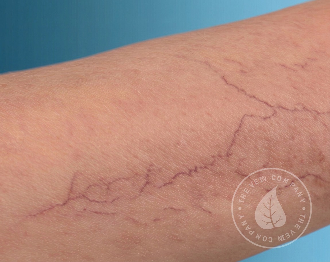 Spider veins on the legs