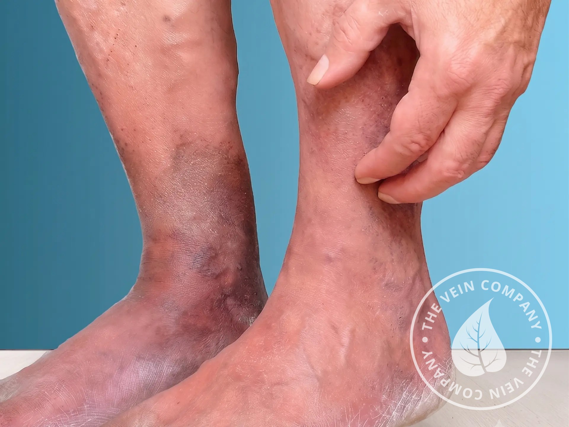 Legs with varicose veins associated with itching and burning.