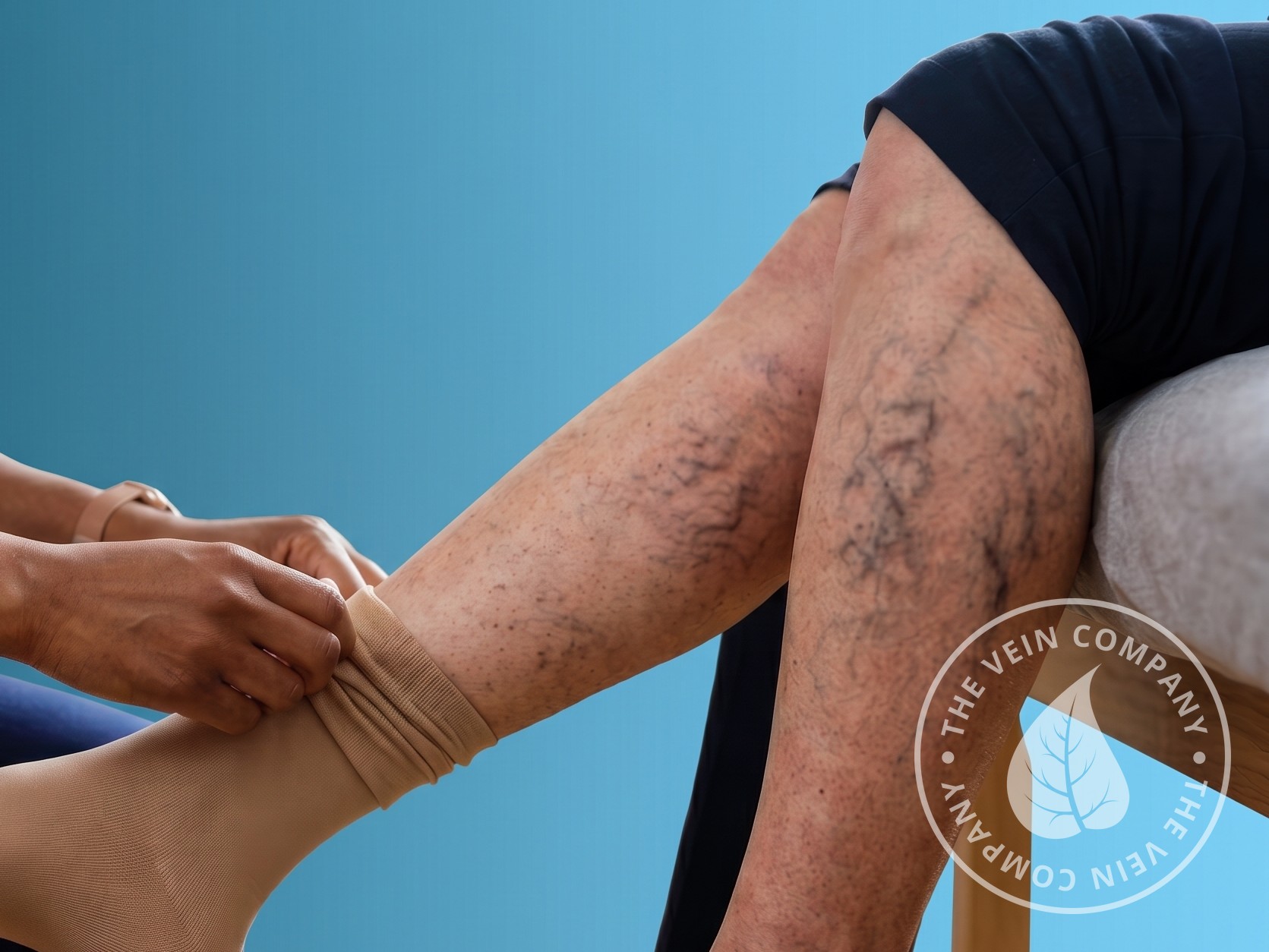 Legs with visible varicose veins associated with heaviness.