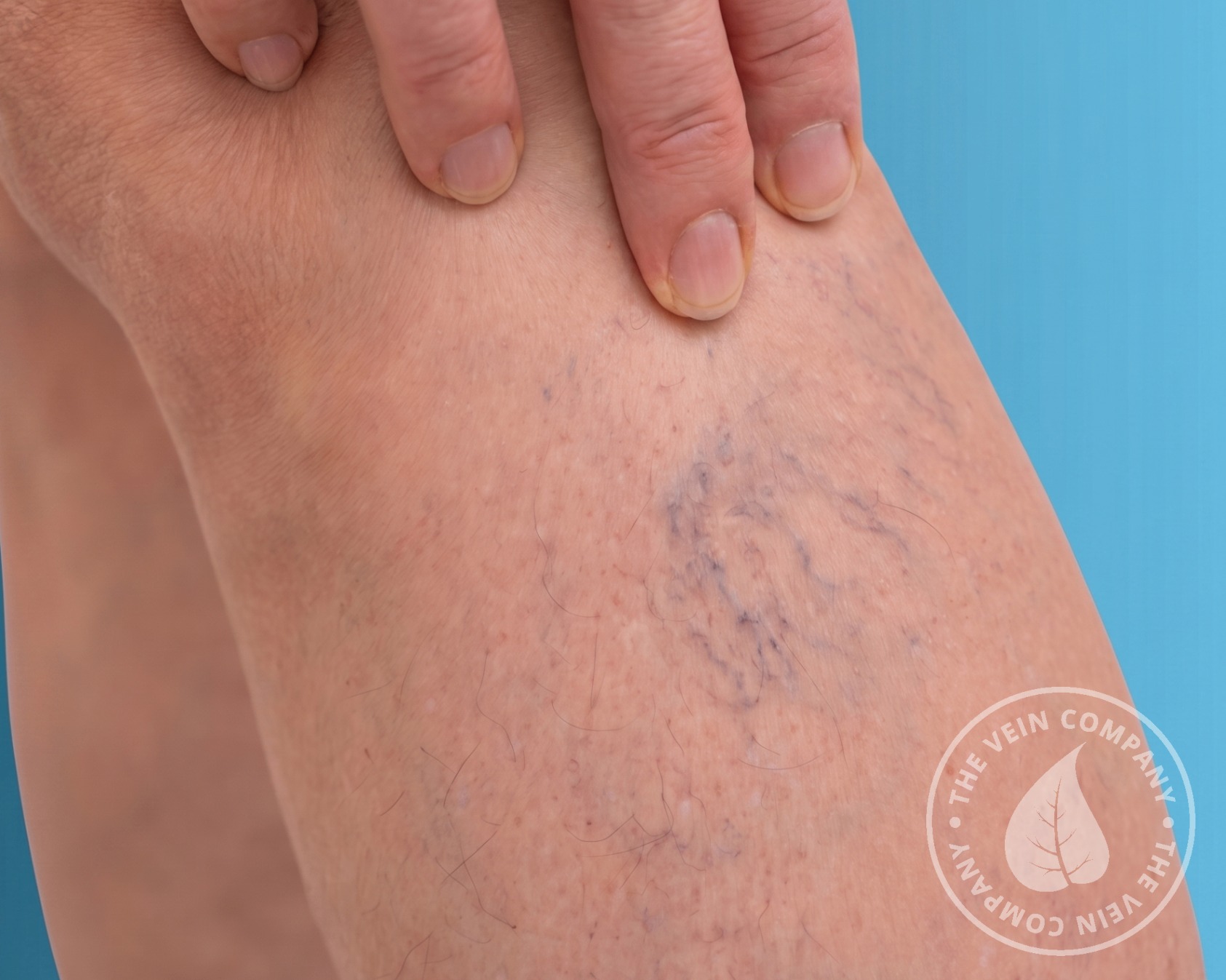 Close-up of reticular veins on the skin — short, jagged, branch-like blue and greenish veins just below the surface.