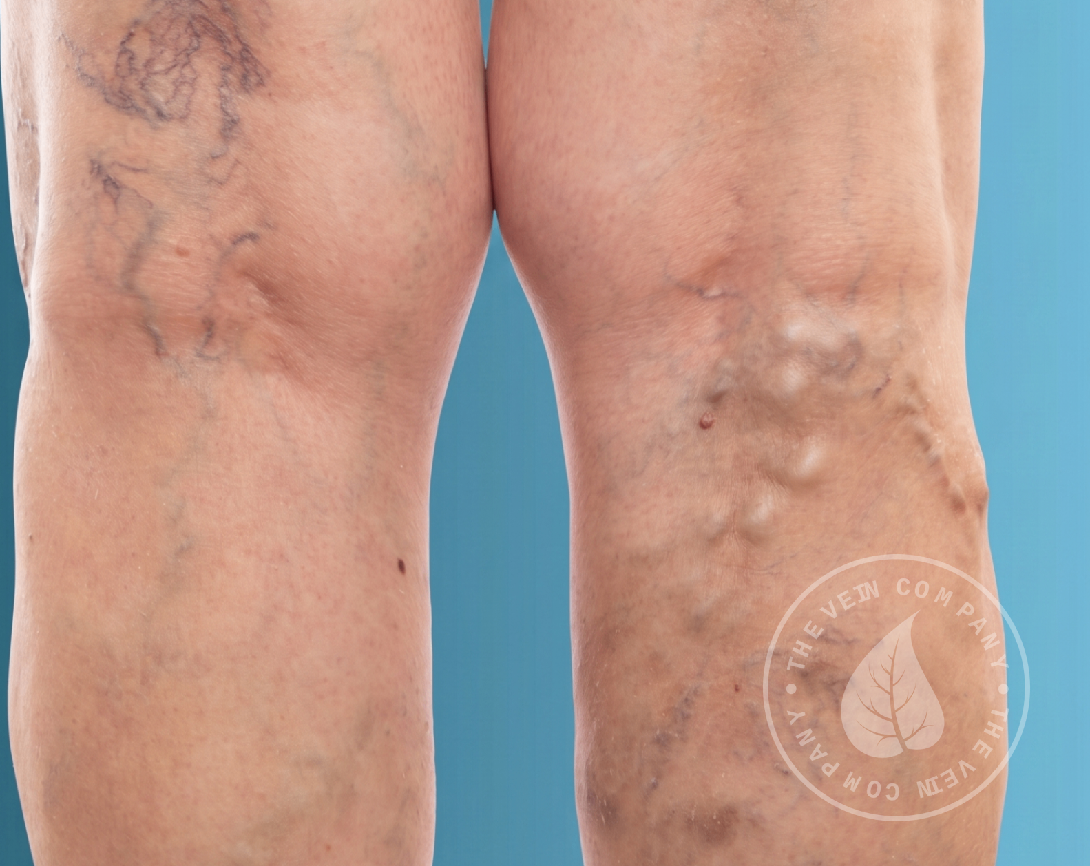 Clinical photo of legs showing visible bulging, twisted varicose veins and surface vein changes.