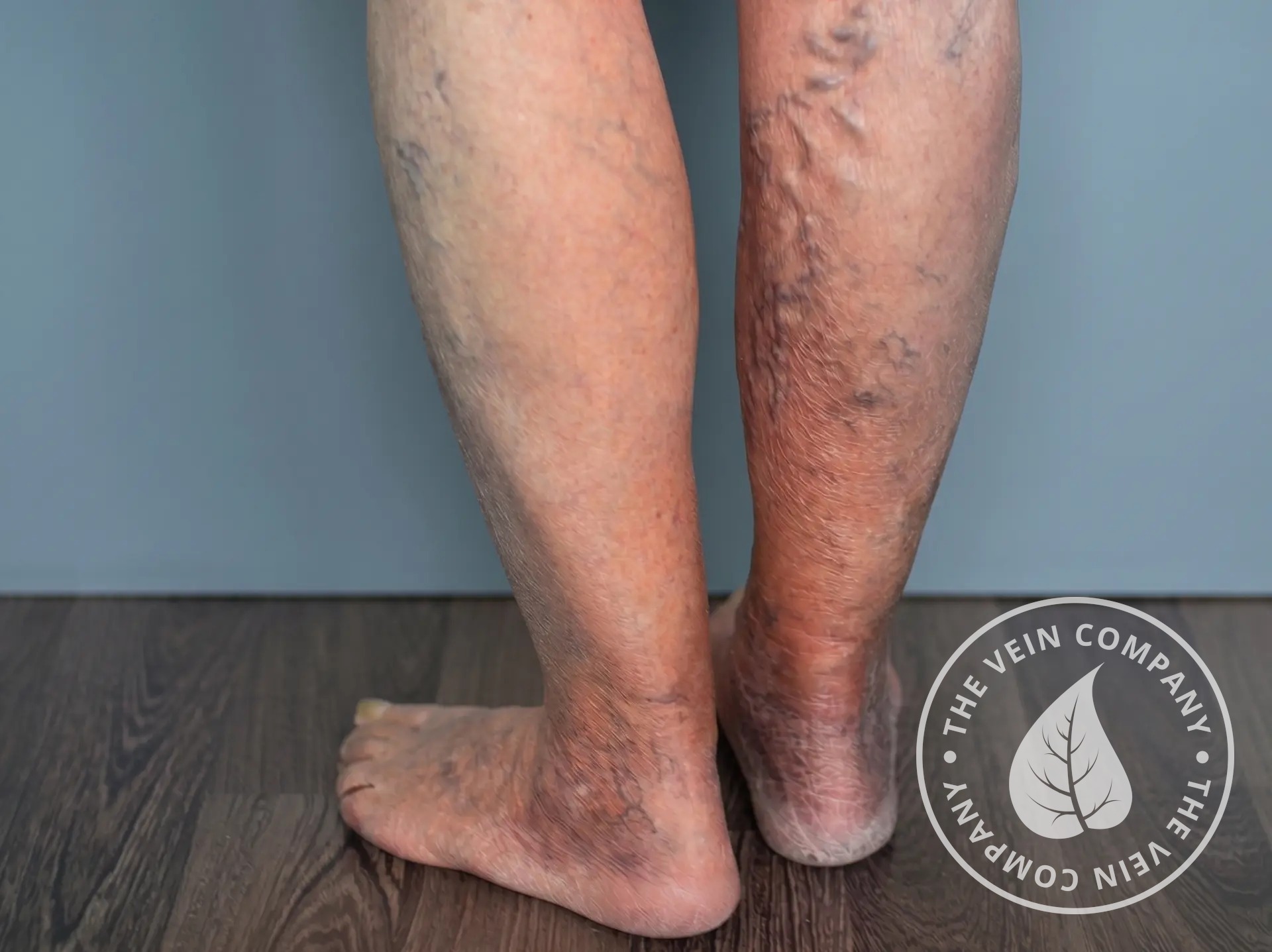 Skin discoloration over varicose veins.