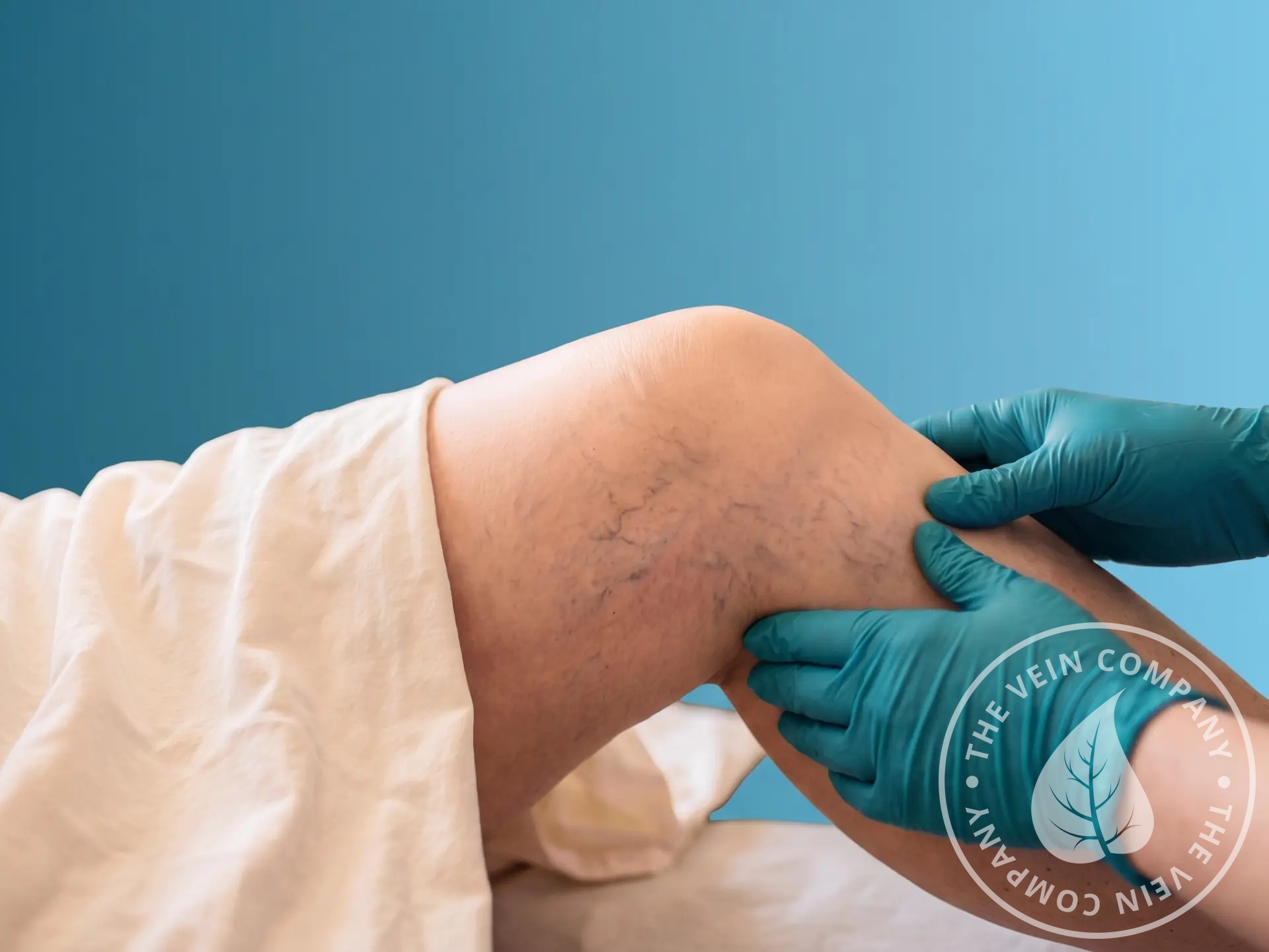 Lower leg swelling associated with varicose veins.