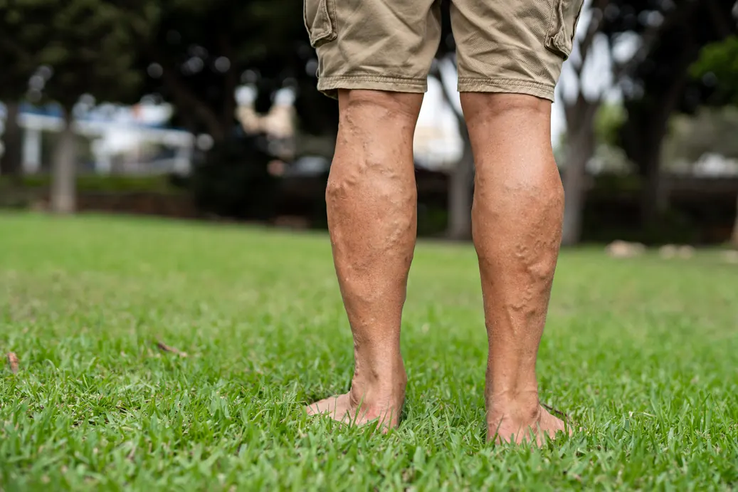 Varicose Veins