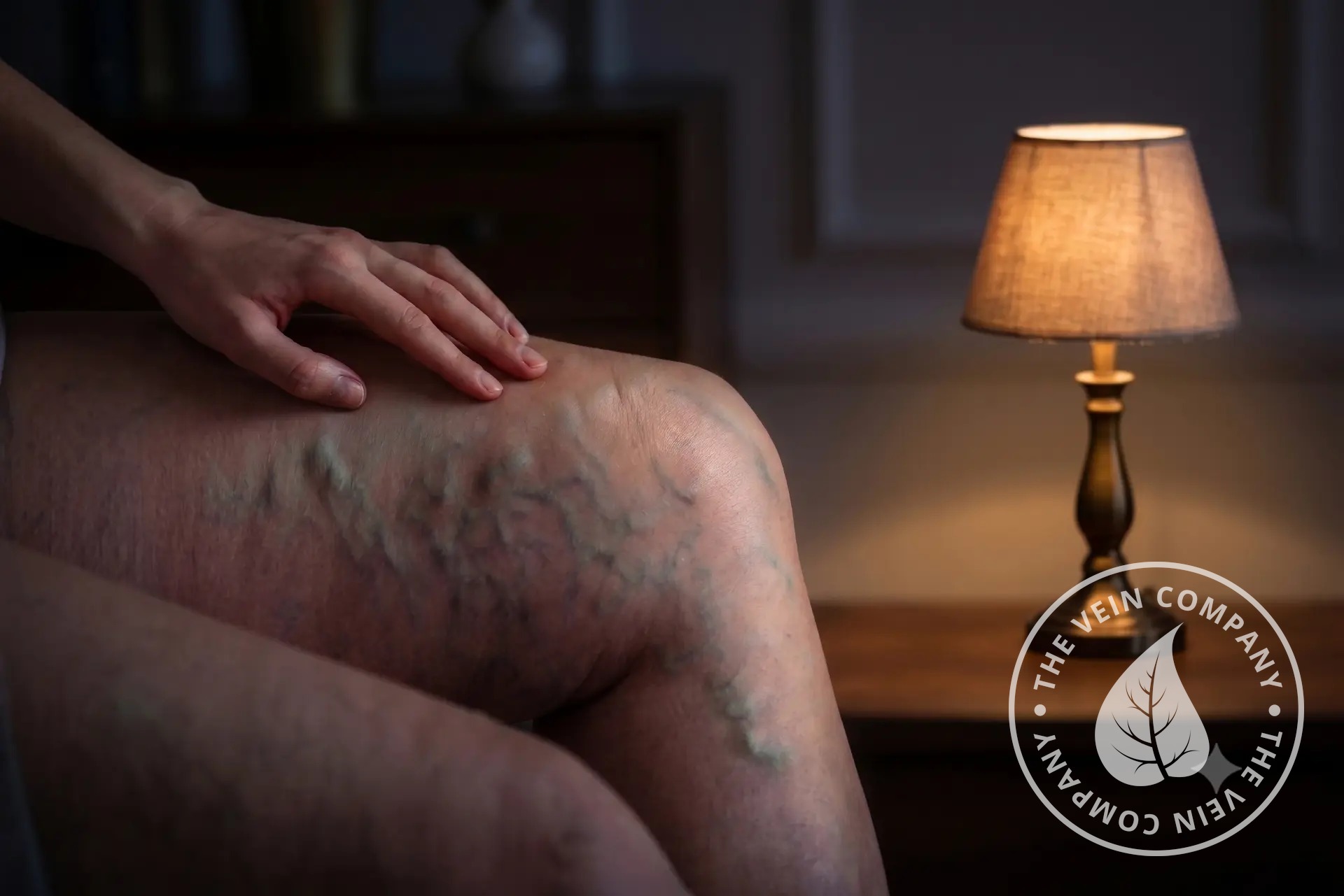 Legs with varicose veins associated with night cramps.