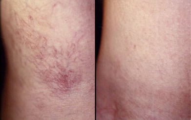 A side-by-side comparison of spider veins on the skin before and after treatment, showing a significant reduction in visible red and purple vascular clusters.