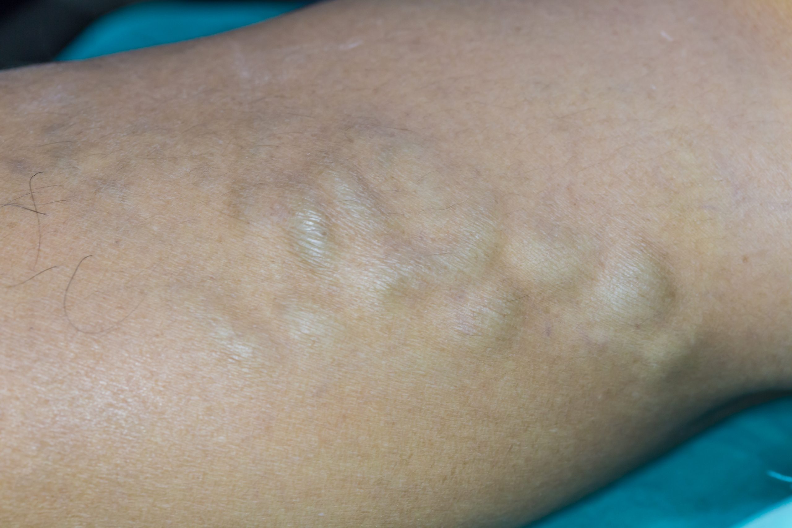 Extreme close-up of skin featuring raised, lumpy, and protruding varicose veins on a person's leg.