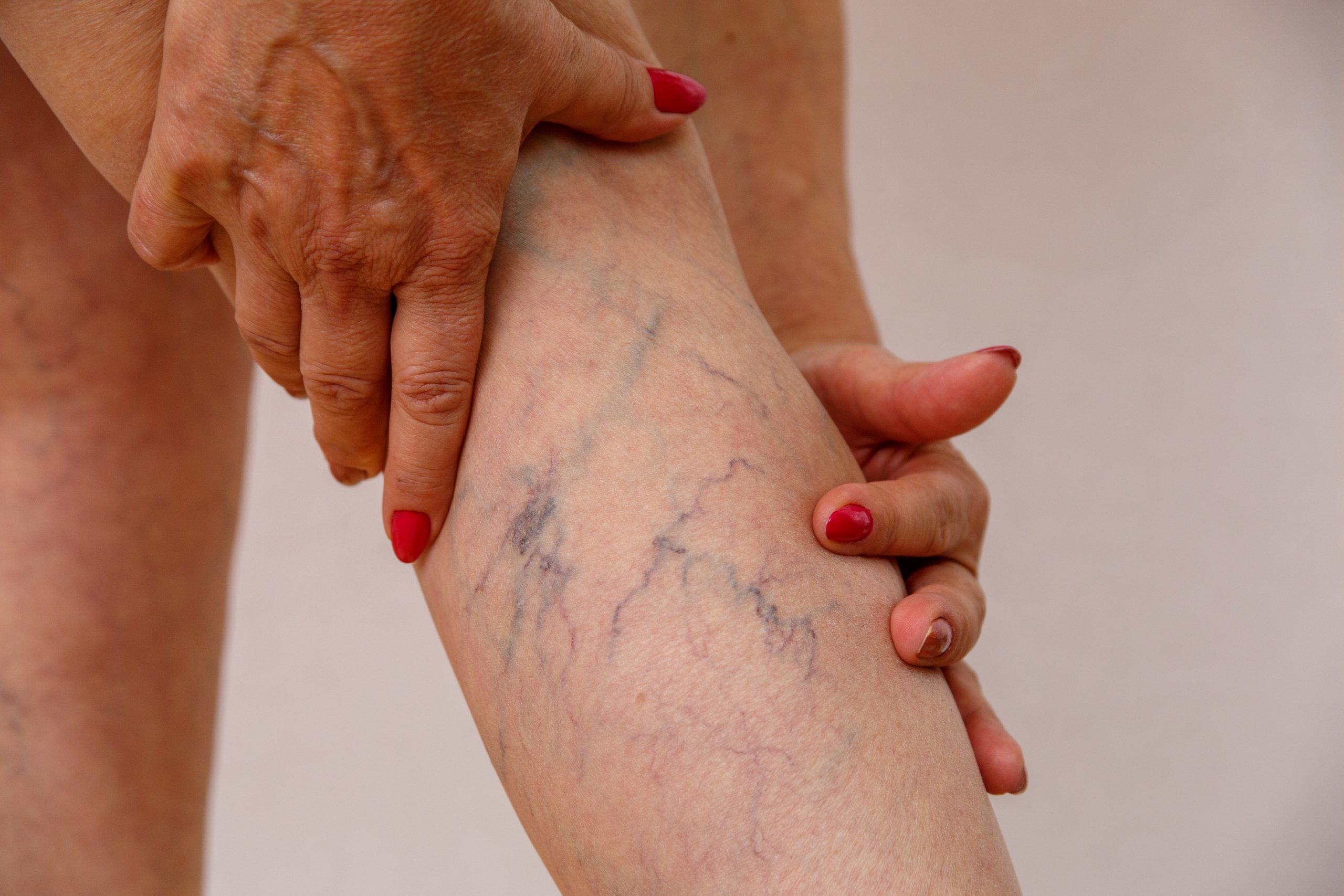 A close-up of a person's leg showing visible purple and blue spider veins, with hands gently holding the leg to highlight the affected area.