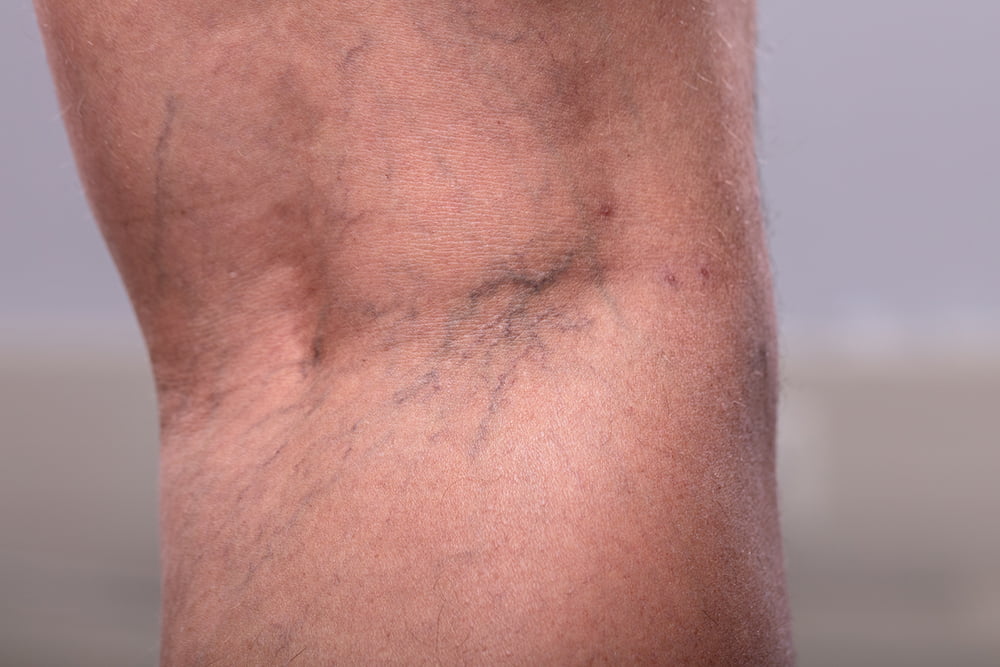 A close-up view of the back of a person's knee showing visible blue and purple spider veins under the skin.