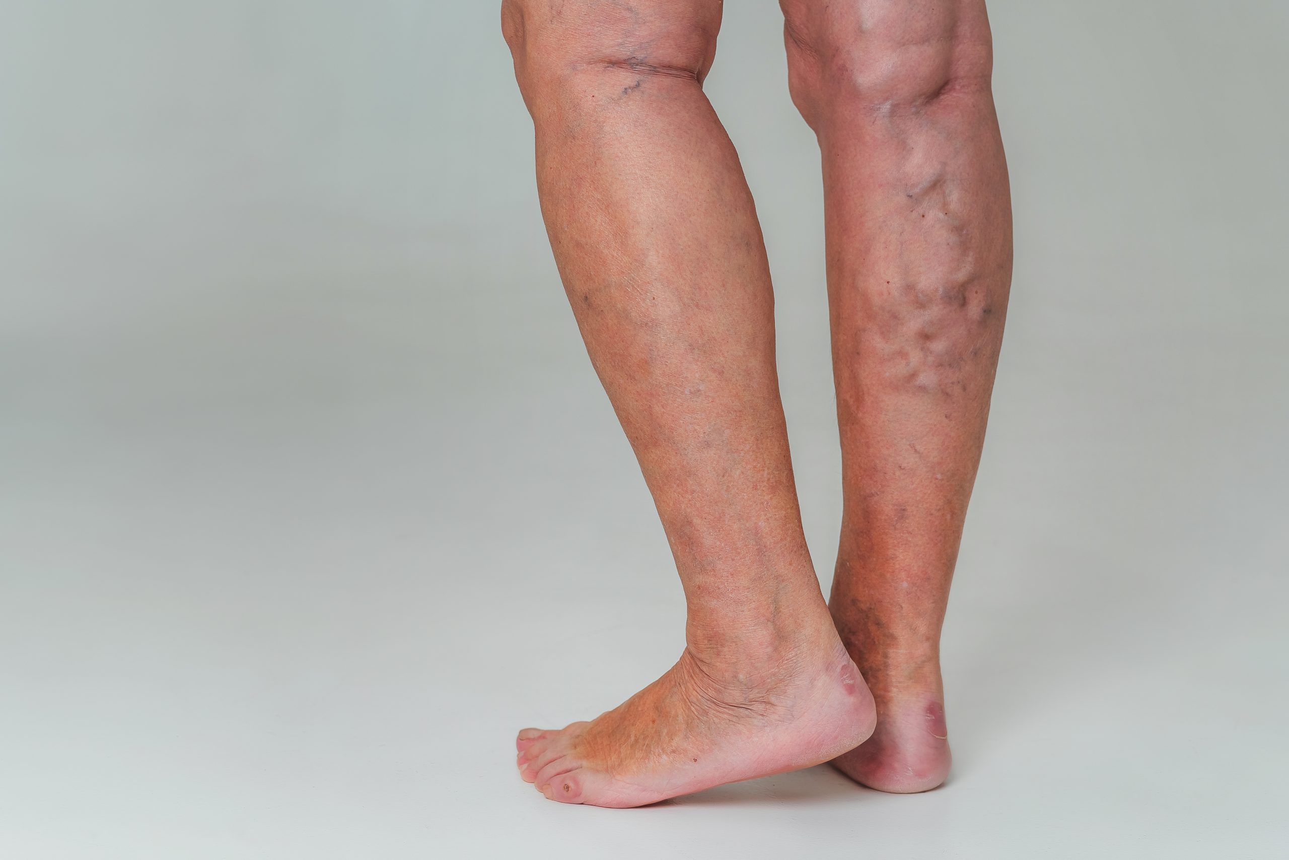 A side view of a person's lower legs and feet showing prominent, bulging varicose veins on the calf and back of the leg against a light gray background.