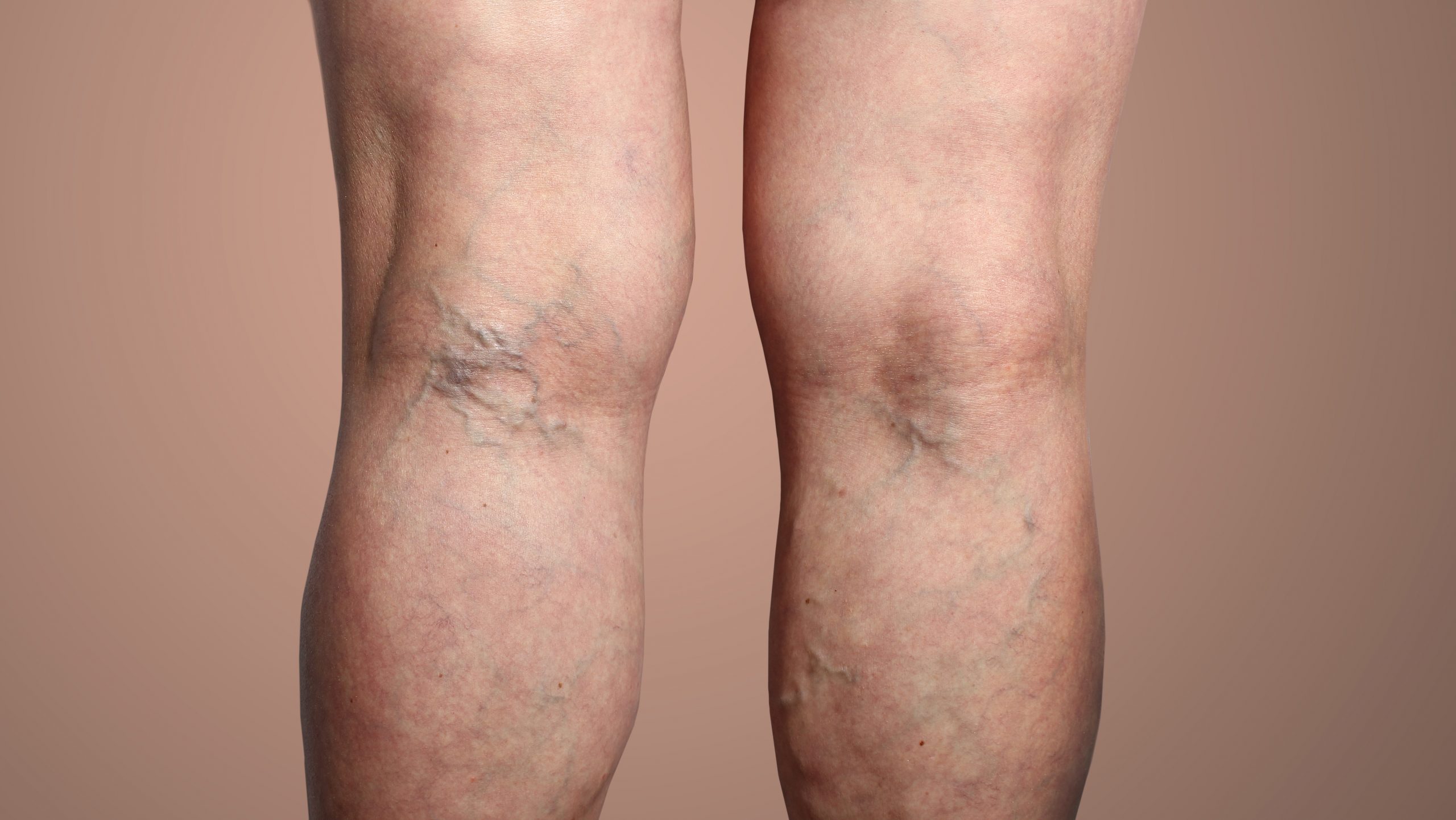 A front-facing view of a person's legs from the mid-thigh to the calf, showing visible varicose and spider veins around both knees.