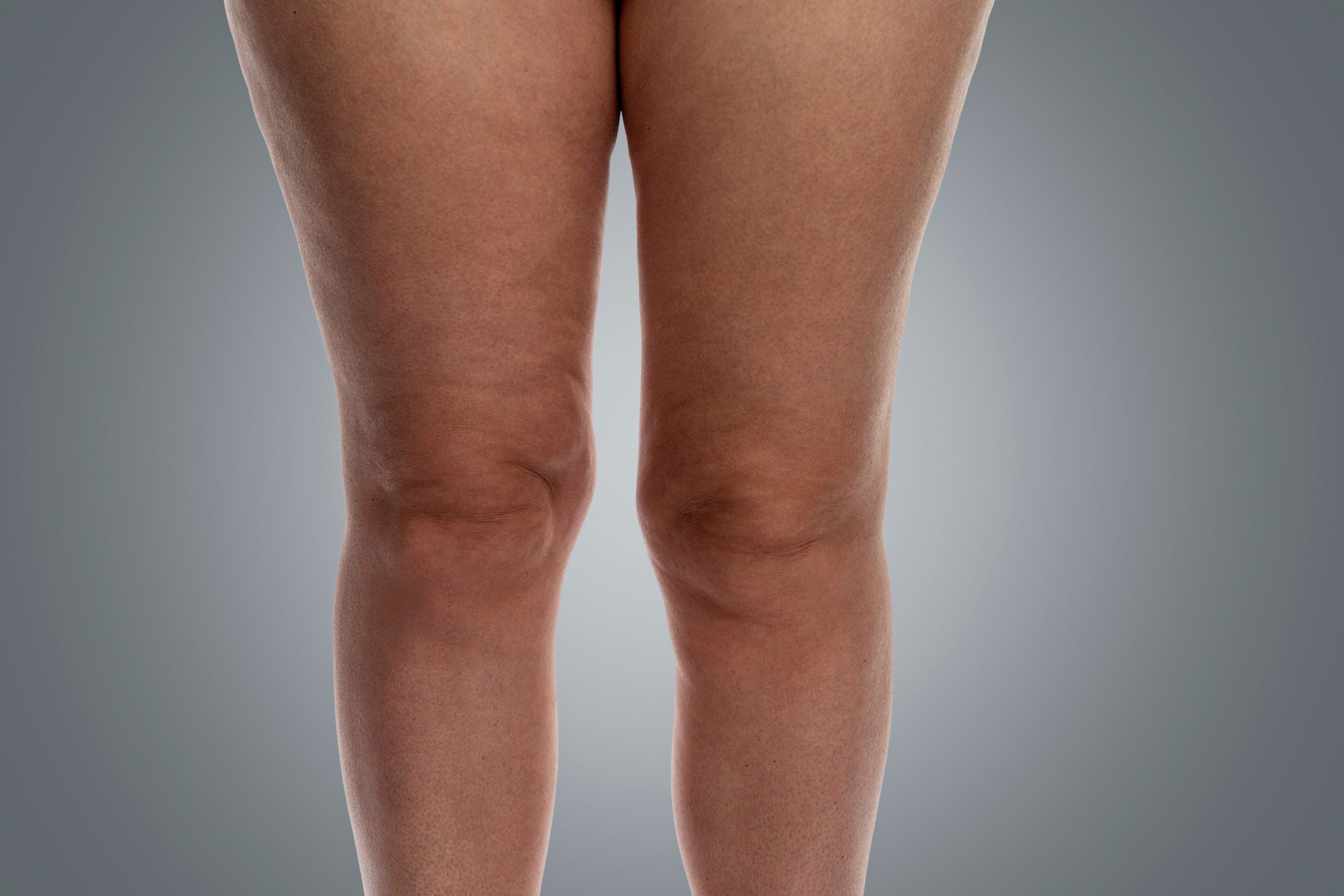 A front-facing studio shot of a person's legs from the upper thigh to the calf, showing skin texture and early signs of visible vein patterns around the knees against a grey gradient background.