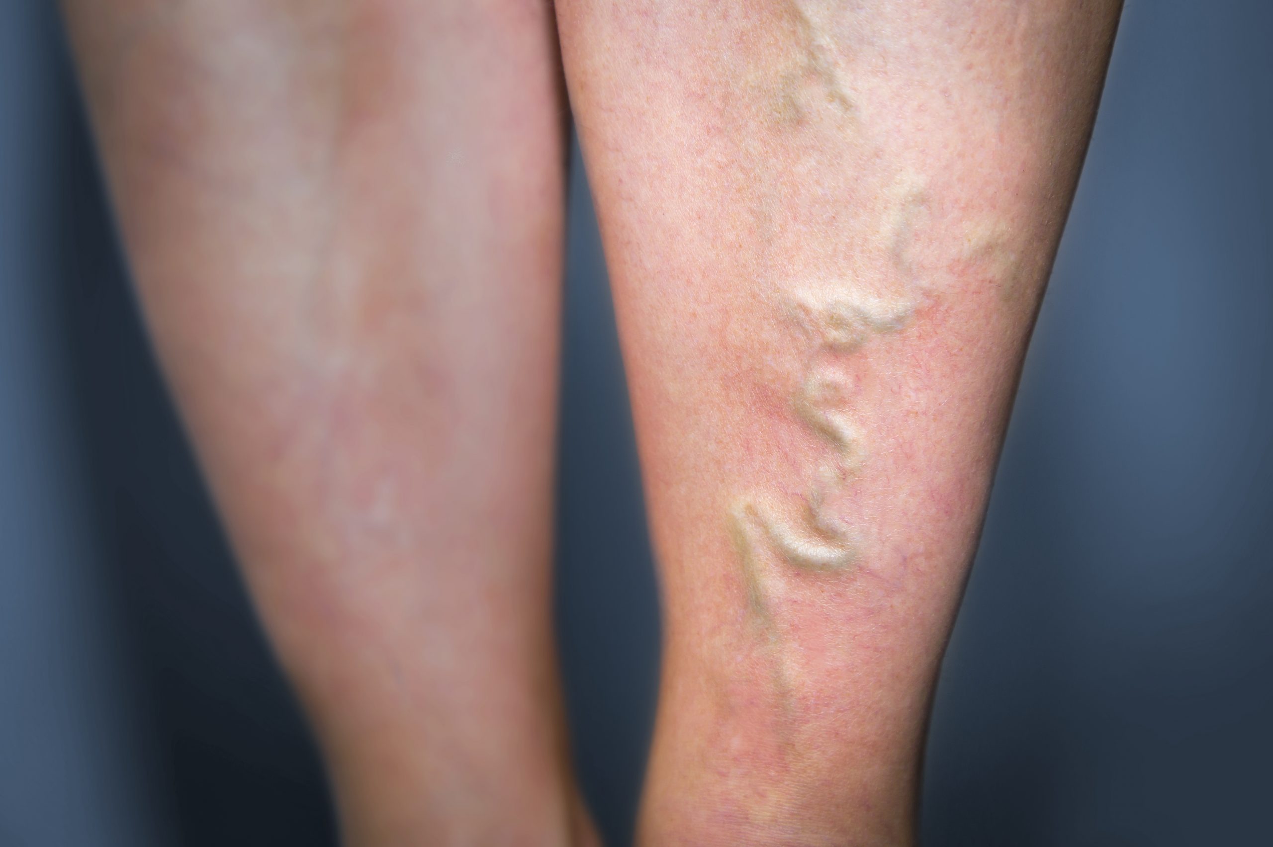 A close-up of a person's lower leg showing a prominent, raised, and twisted varicose vein running vertically down the calf.