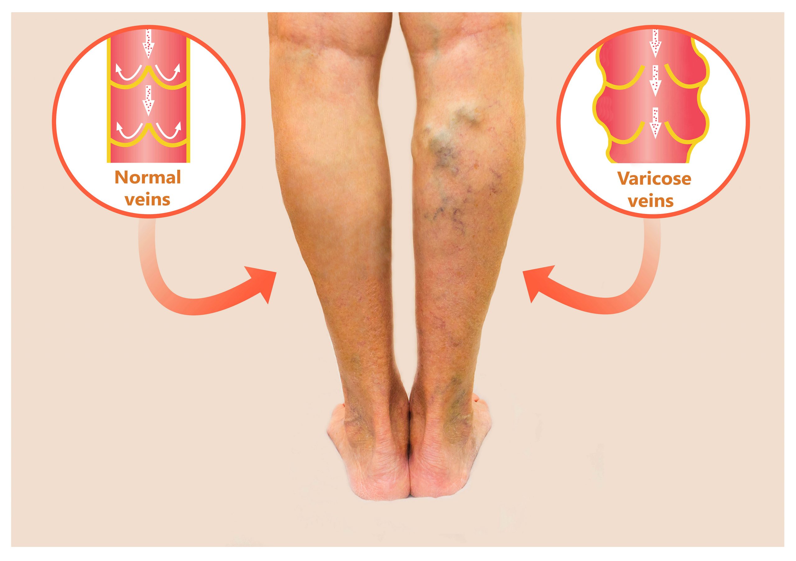 An infographic showing the back of a person's legs with visible varicose veins, featuring two circular diagrams comparing a normal vein with healthy valves to a varicose vein with damaged valves and blood pooling.