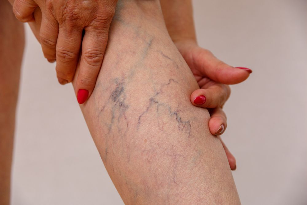 Close-up of a person's leg with visible spider veins and reticular veins being held by hands with red nail polish.