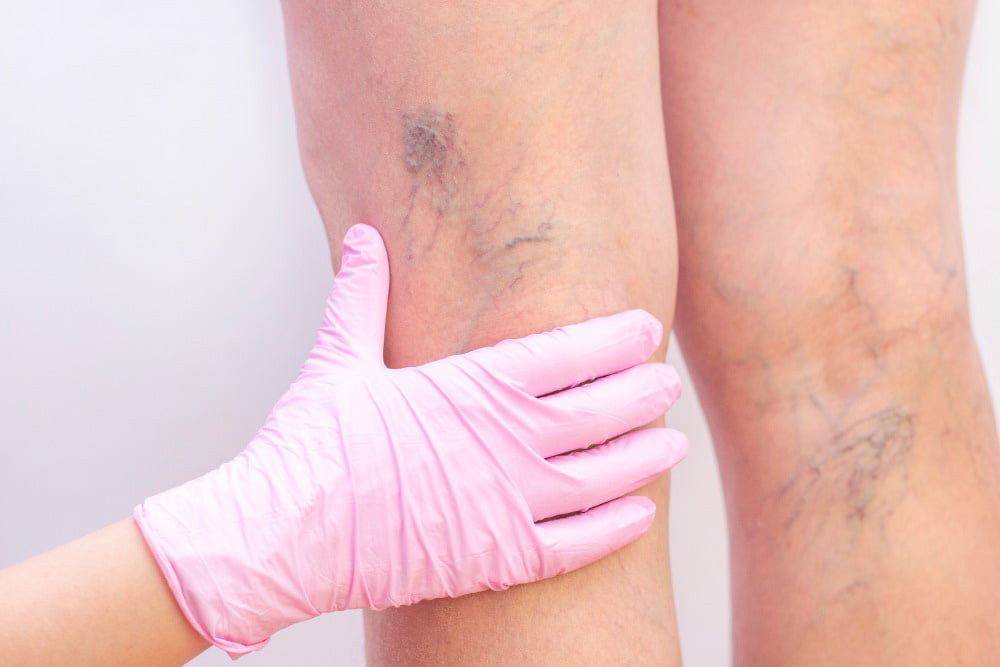 Close-up of a person's legs showing visible spider veins and varicose veins, with a hand in a pink medical glove touching the back of the knee.