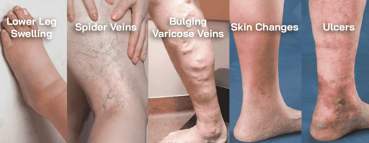 A medical infographic showing five stages of venous disease with labeled photographic examples: Lower Leg Swelling, Spider Veins, Bulging Varicose Veins, Skin Changes, and Ulcers.