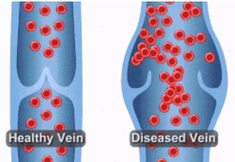 Medical illustration comparing a healthy vein and a diseased vein, showing red blood cells flowing through functional valves on the left versus blood pooling and refluxing through weakened valves in a dilated vessel on the right.