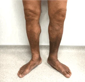 An anatomical medical illustration showing a cross-section of a healthy vein compared to a vein affected by superficial venous reflux disease, demonstrating blood backflow and pooling.