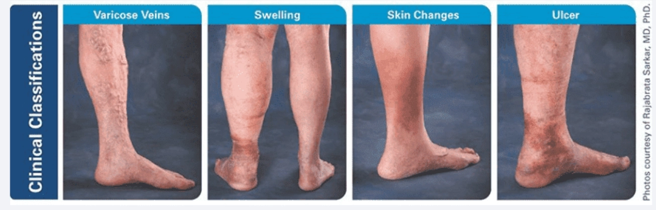 A medical infographic titled "Clinical Classifications" showing four stages of venous disease: Varicose Veins, Swelling, Skin Changes, and Ulcer, each illustrated with a photo of a human leg.