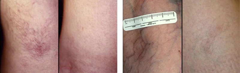 A side-by-side medical before-and-after comparison showing the successful treatment of spider veins on a patient's leg.