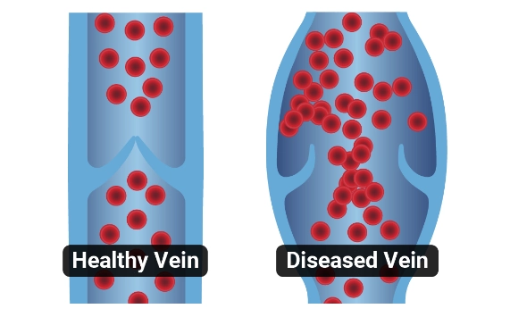 Medical illustration comparing a healthy vein and a diseased vein, showing red blood cells flowing through functional valves on the left versus blood pooling and refluxing through weakened valves in a dilated vessel on the right.