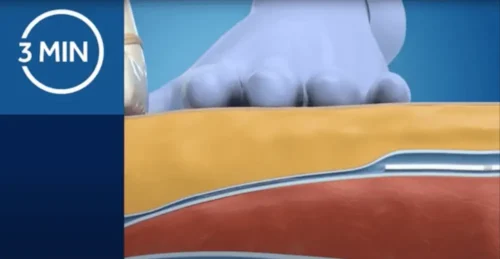 VenaSeal™ Closure System – Treatment