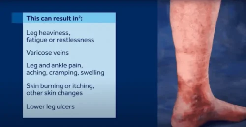 Venous Reflux Disease – Treatment