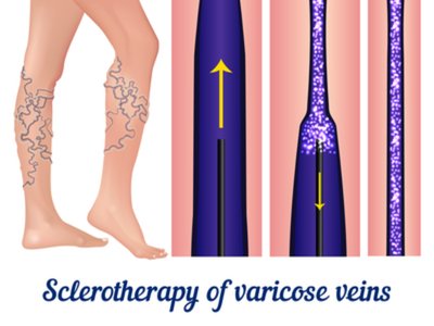 Sclerotherapy treatment