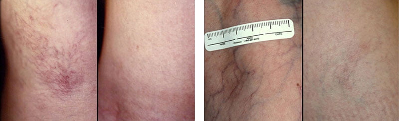 Spider Veins
