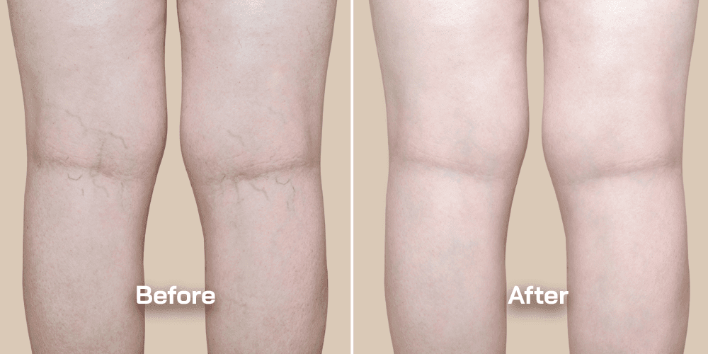 Vein treatment before and after