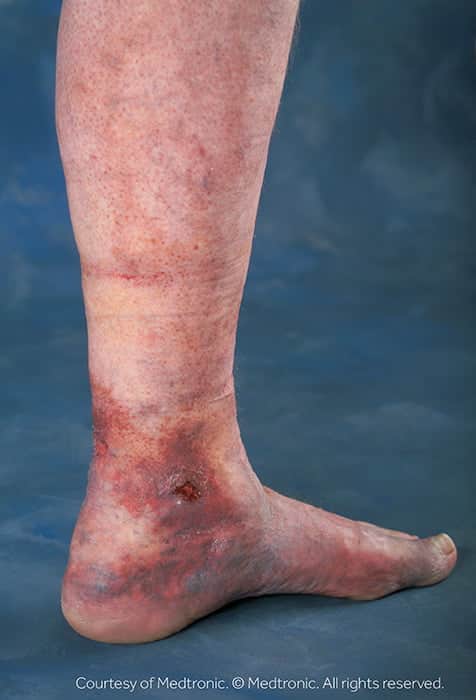 Leg Wound or Sore