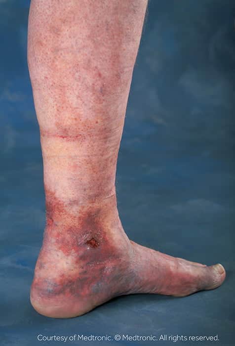 Veins Compression Stockings, Heal Skin Ulcers Varicose Veins