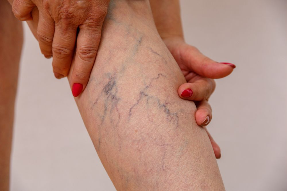 Is Varicose Vein Treatment Covered by Insurance?